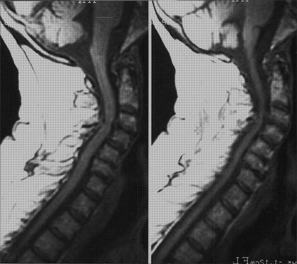 Los 21 Mejores Andadores Hernias De Discos