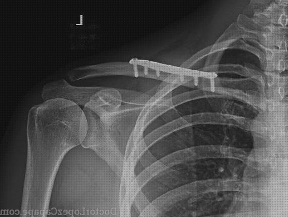 Las mejores marcas de aparato ortopedico para clavicula
