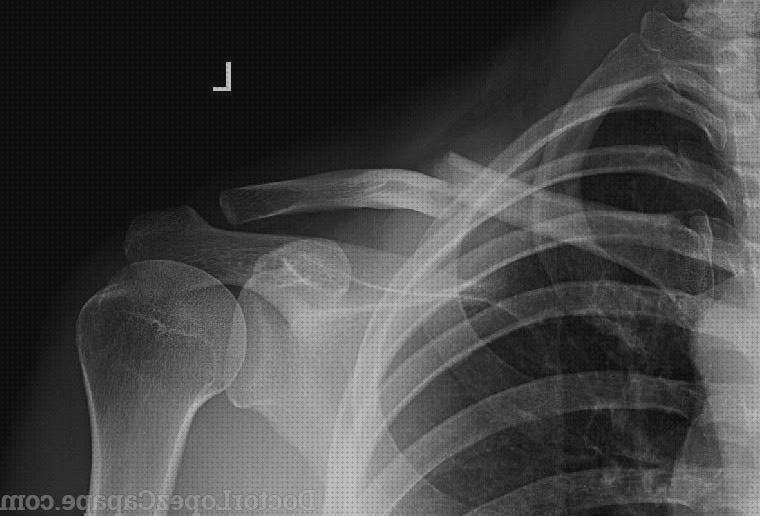 Los 23 Mejores Aparatos Ortopedicos Para Clavicula