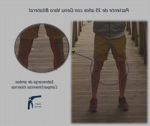 Review de aparato ortopedico para desgaste rodilla