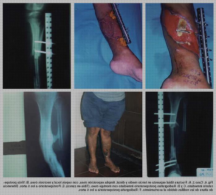 Las mejores aparatos ortopedicos aparatos ortopedicos para tibia y perone
