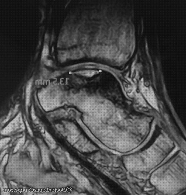 Las mejores bota ortopedica para edema oseo