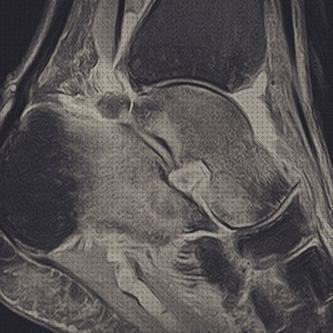 Opiniones de las 13 mejores Botas Ortopedicas Para Edemas Oseo