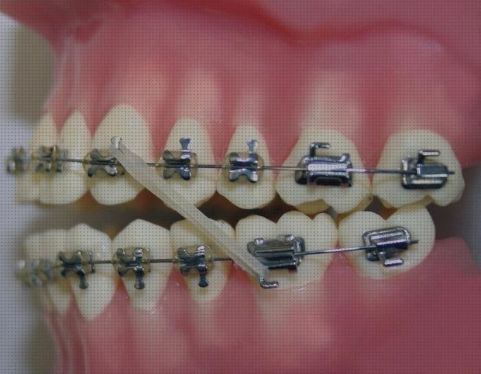 Review de brackets ortopedicos