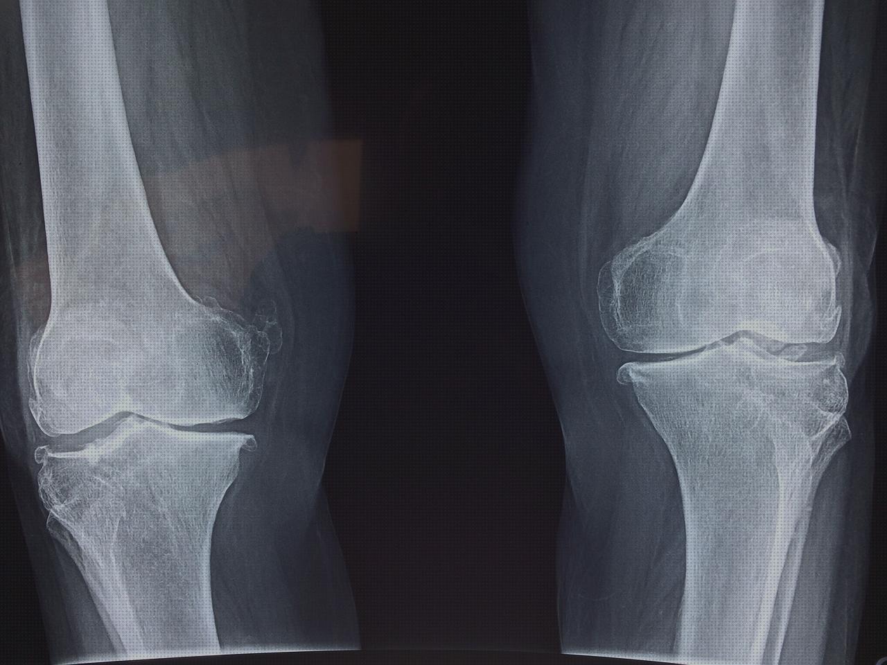 Las mejores 13 Amputacion Supramaleolar Adductor Hernia Edema Oseo Subcondral De Rodilla Celdas 42