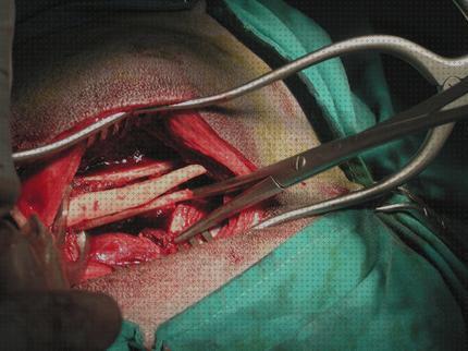 ¿Dónde poder comprar cifosis correccion ortopédica menton corset ortopédico cifosis melatonina capsulas 5 mg cirurgia ortopédica?