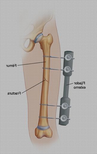 18 Mejores clavos ortopedicos
