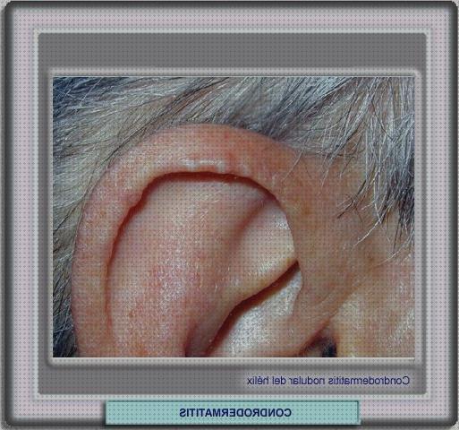 ¿Dónde poder comprar adductor hernia edema oseo subcondral de rodilla ortopedia bami condrodermatitis oreja tratamiento?