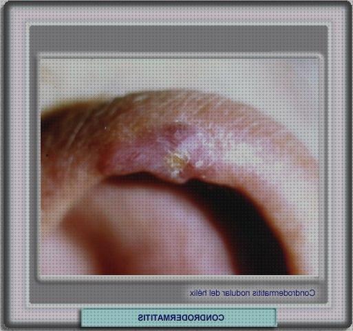 Las mejores adductor hernia edema oseo subcondral de rodilla ortopedia bami condrodermatitis oreja tratamiento