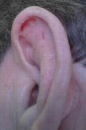 Review de condrodermatitis oreja tratamiento
