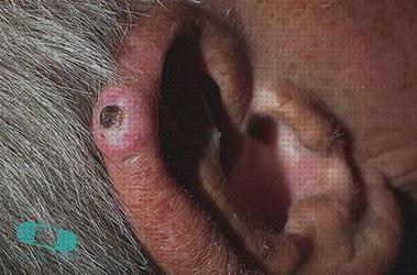 Los 13 Mejores condrodermatitis orejas tratamientos