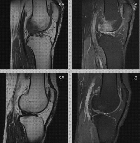 Review de edema oseo rodilla rehabilitacion