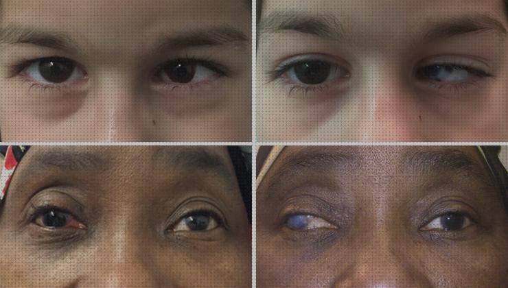 Las 11 Mejores Lentillas Ortopédicas Antigmatismo