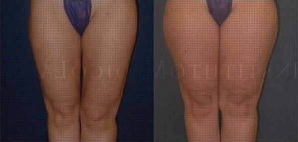 Las mejores marcas de andador piernas lipolaser piernas completas