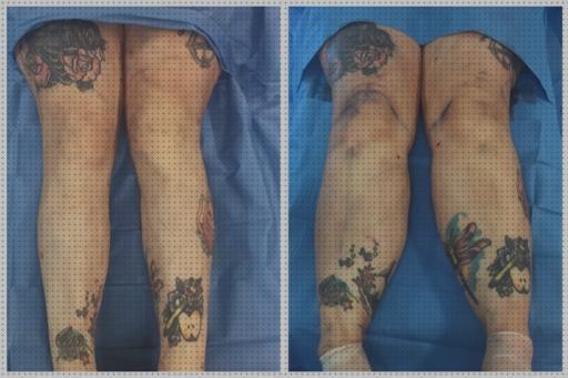 Las mejores andador piernas lipolaser piernas completas