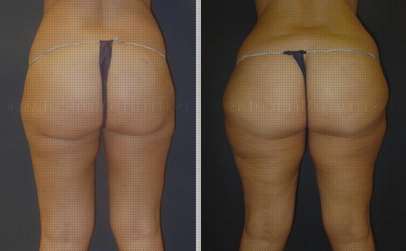 Review de lipolaser piernas completas