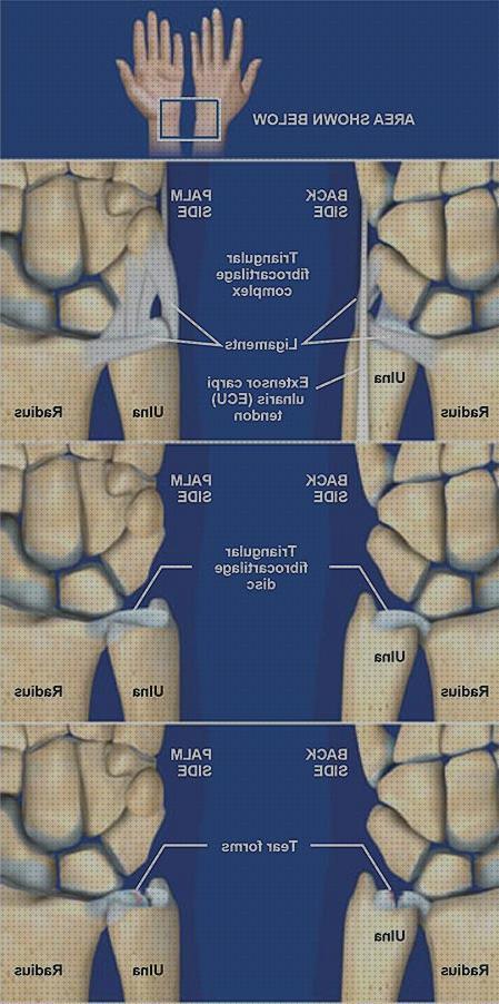 Las 12 Mejores Muñequeras Ortopedicas Fibrocartilago Triangulat
