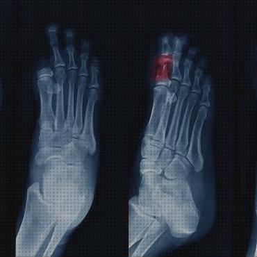 Las mejores ortesis amputacines pie