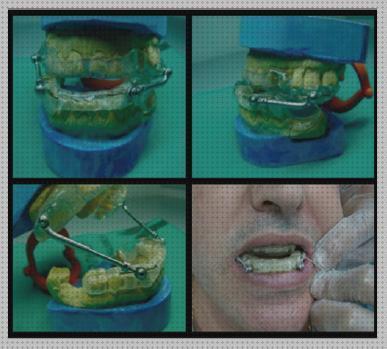 Las mejores 15 Ortesis De Avances Mandibular