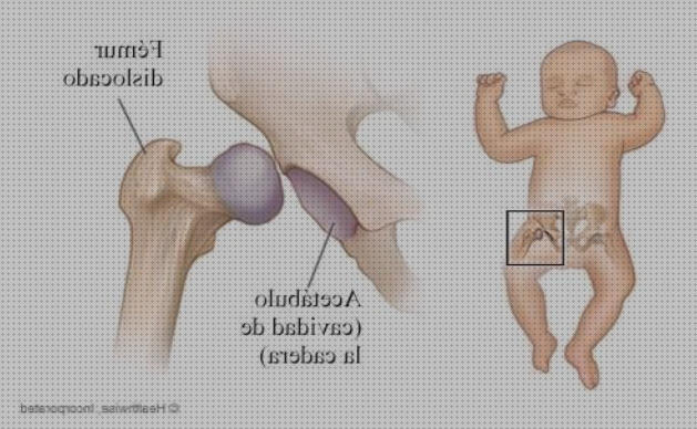 Opiniones de las 15 mejores Ortesis Displasias Congenita De Caderas