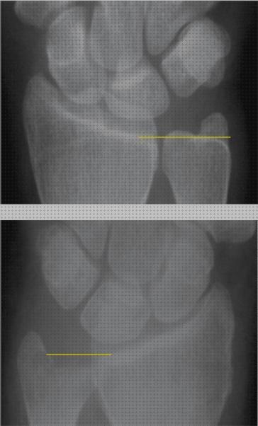 ¿Dónde poder comprar ortesis de bobath ortesis de nike neuroma de morton ortesis ortesis muñeca cubito minus?