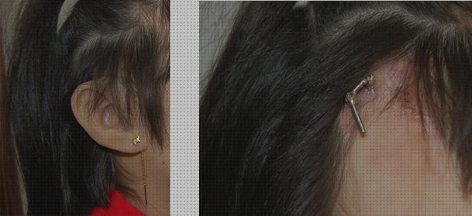 Las mejores orejas ortesis oreja