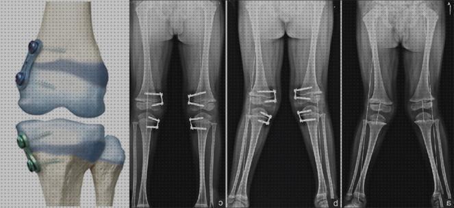 ¿Dónde poder comprar ortesis para rodilla valga?