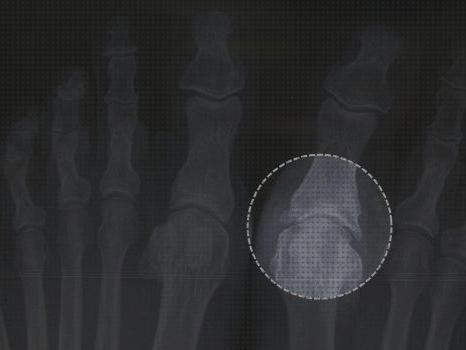 Las mejores plantar ortesis ortesis plantar con kinetic wedge
