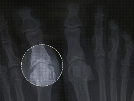 ¿Dónde poder comprar plantar ortesis ortesis plantar con kinetic wedge?