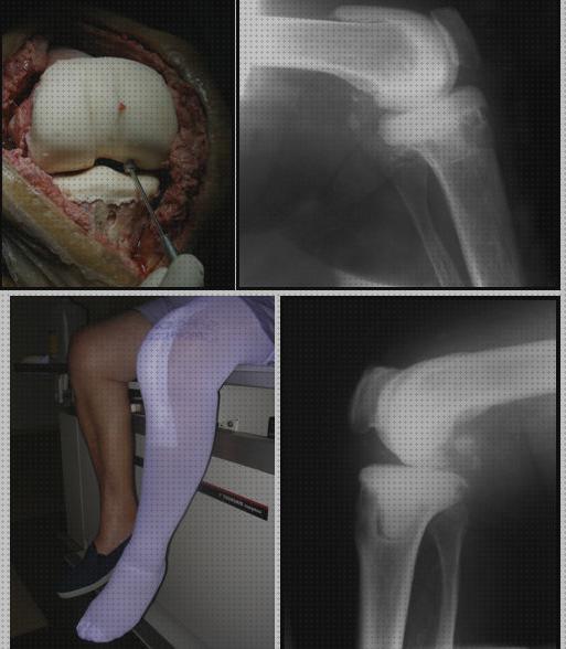 Opiniones de las 15 mejores Ortesis Post Quira Rgica De Caderas