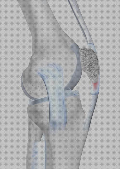 Las mejores tendon ortesis ortesis rotura tendon rotulina