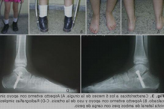 ¿Dónde poder comprar tendon ortesis ortesis tendon peroneo?