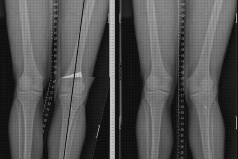 Opiniones de liposuccion pubis hombre edema oseo subcondral de rodilla ortopedia bami osteopatia de pubis tratamiento quirurgico