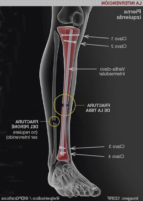Las mejores marcas de andador ortopédico titanio cifosis correccion ortopédica menton corset ortopédico cifosis pierna tibial ortopédica de titanio
