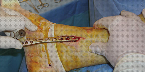 Review de pierna tibial ortopédica de titanio