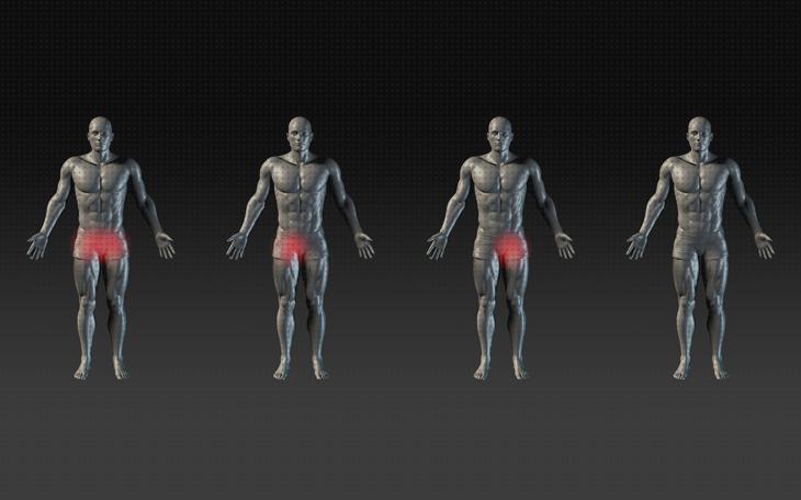 Las mejores hernia deportiva pubalgia disras orejas orejas ortopédicas pubalgia en mujeres