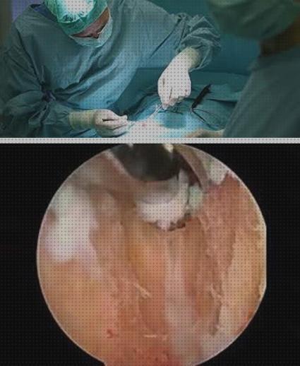 Review de pubalgia en mujeres