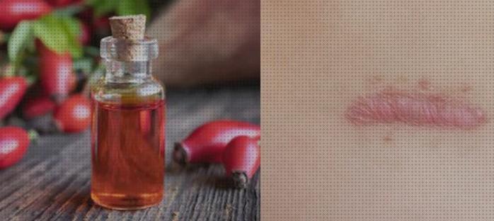 Review de queloides rosa mosqueta
