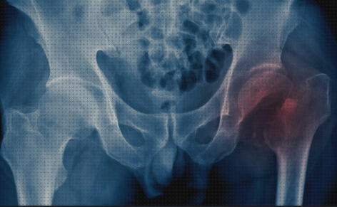Las mejores marcas de radiografia radiografia ortesis fibra de carbono