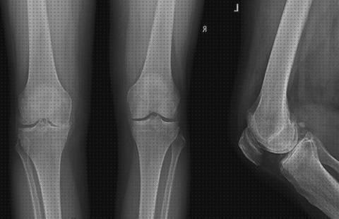 Las mejores marcas de raton ortopédico melatonina capsulas 5 mg colageno hidrolizado capsulas raton articular en la rodilla