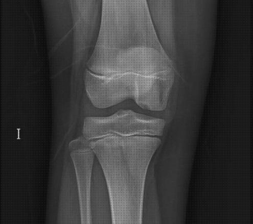 Las mejores raton ortopédico melatonina capsulas 5 mg colageno hidrolizado capsulas raton articular en la rodilla